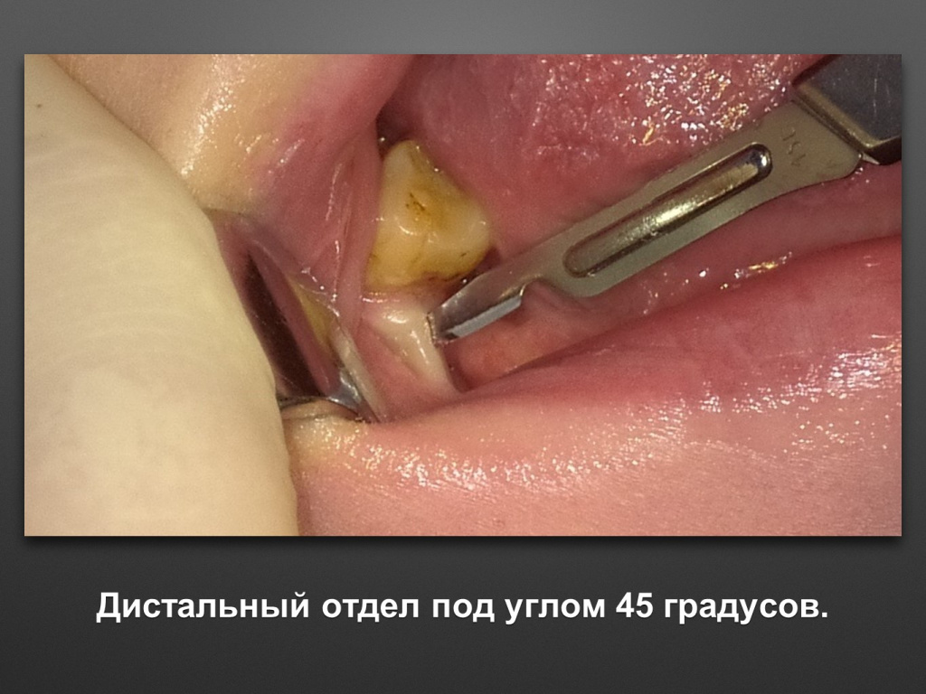 Горизонтальное увеличение альвеолярного отростка