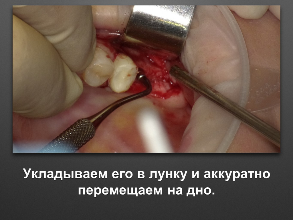 Биоимплант ГАП. Имплантация в дистальном отделе