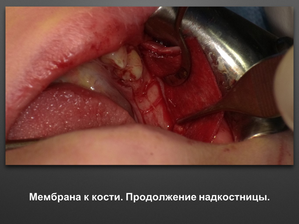 Горизонтальное увеличение альвеолярного отростка