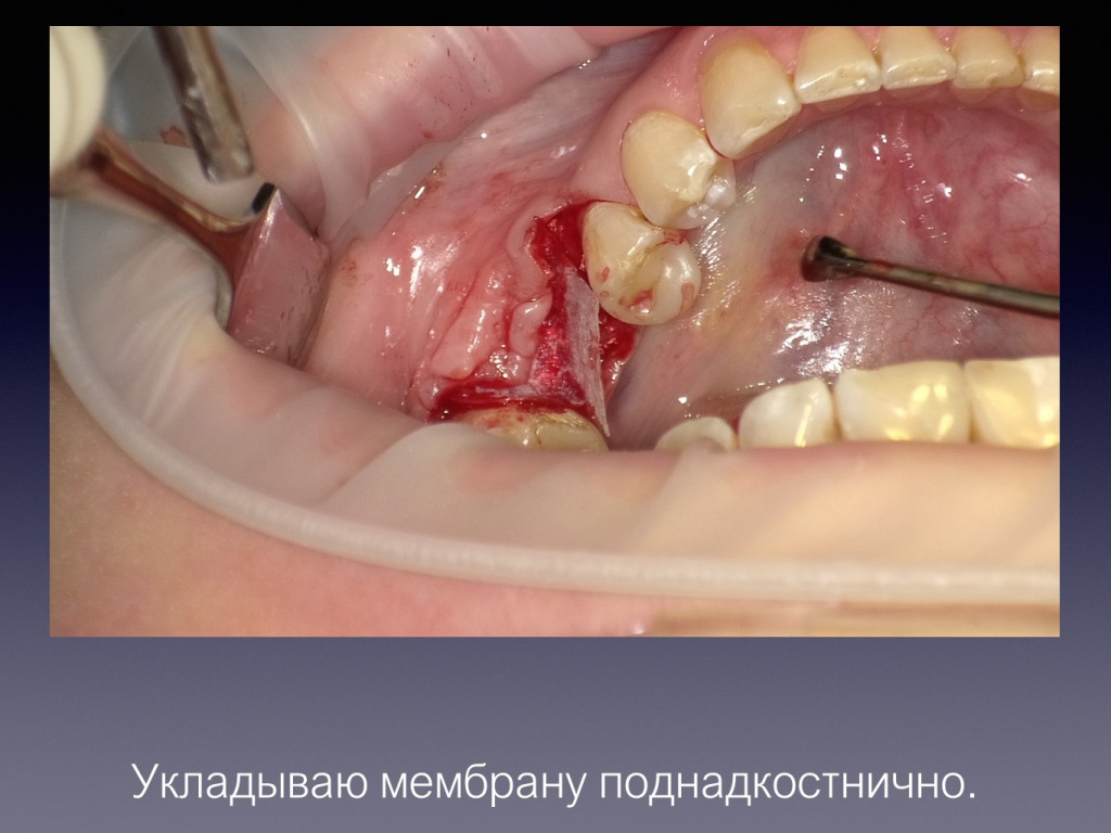 Постановка имплантата после презервации