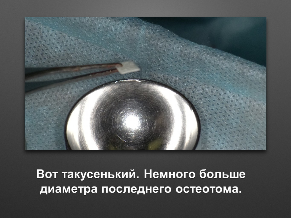 Биоимплант ГАП. Имплантация в дистальном отделе