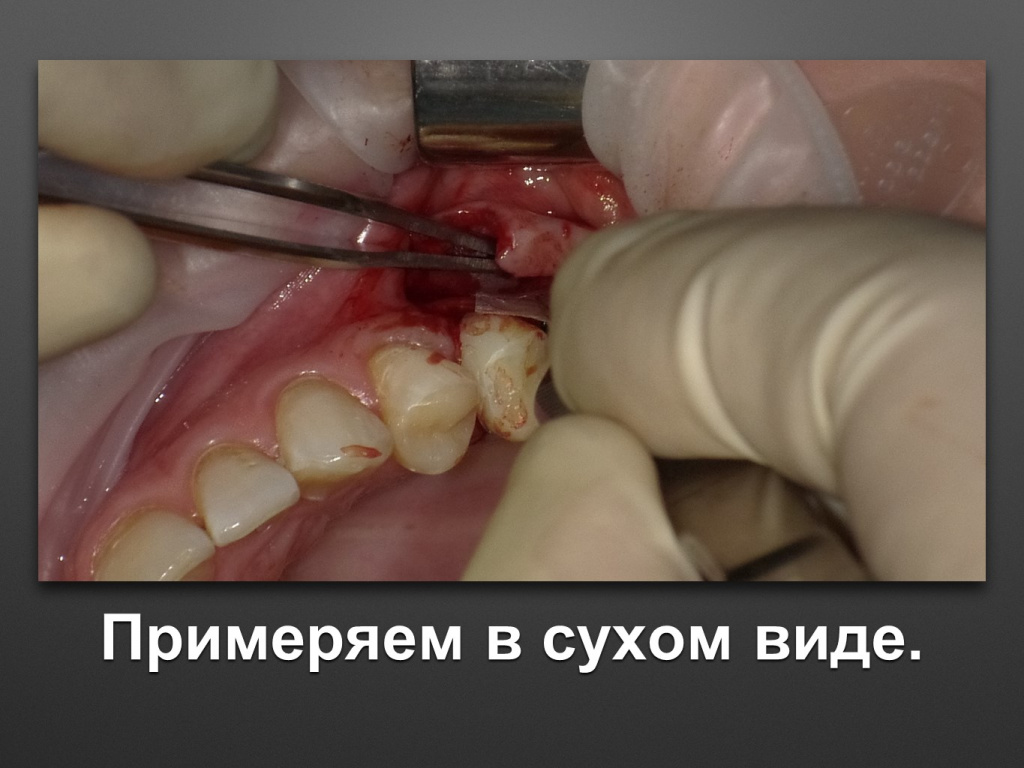 Биоимплант ГАП. Имплантация в дистальном отделе