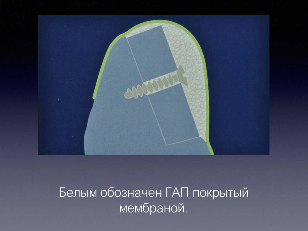 Принцип направленной костной регенерации