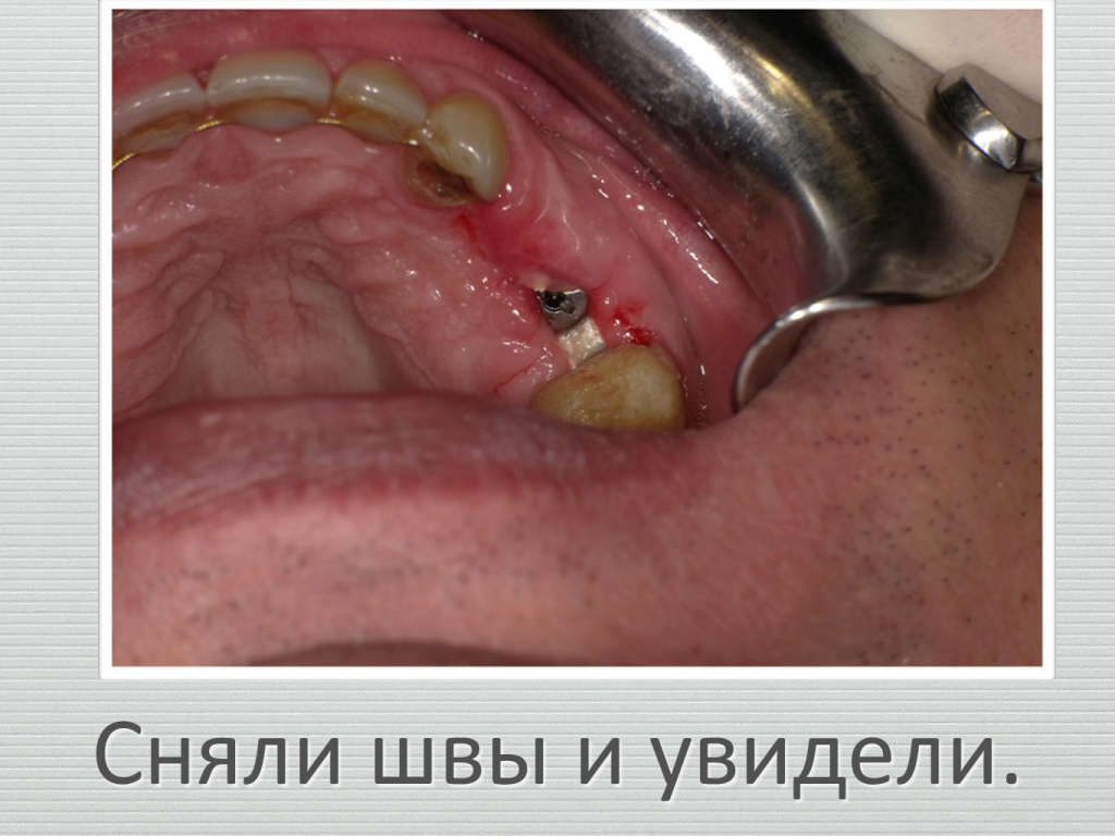 Ранозаживление