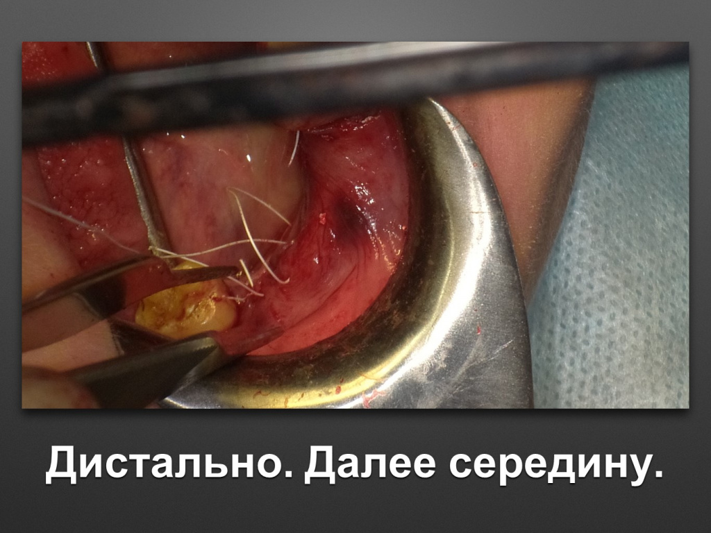 Горизонтальное увеличение альвеолярного отростка
