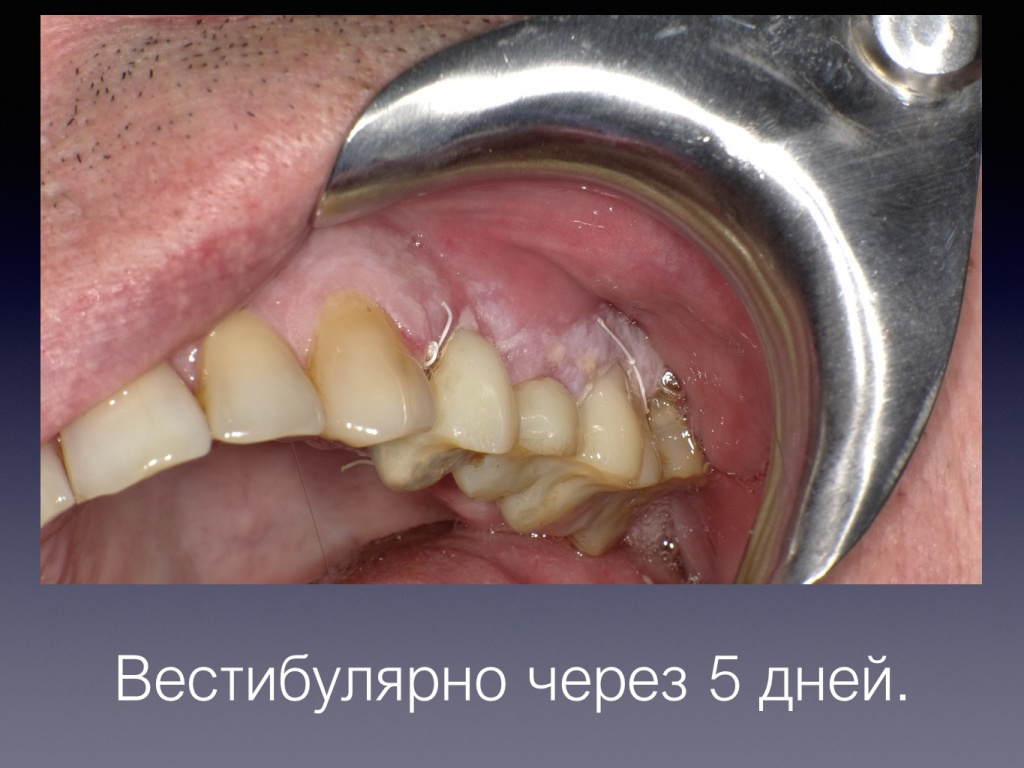 Постановка импланта