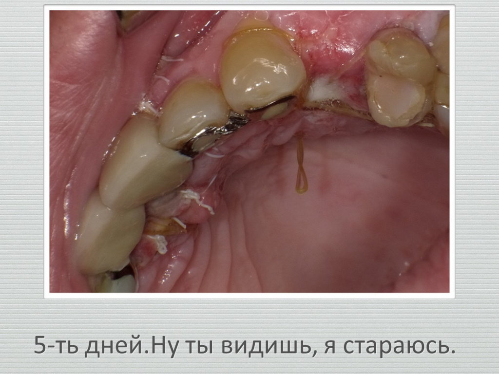 Ранозаживление