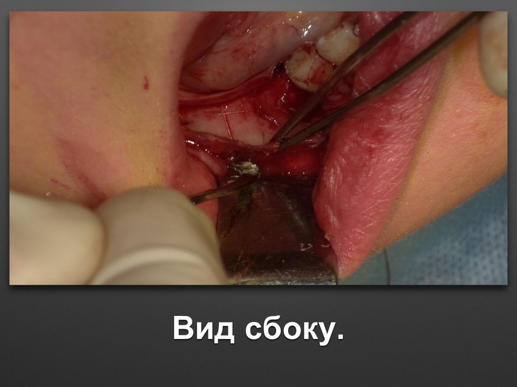 Горизонтальное увеличение альвеолярного отростка