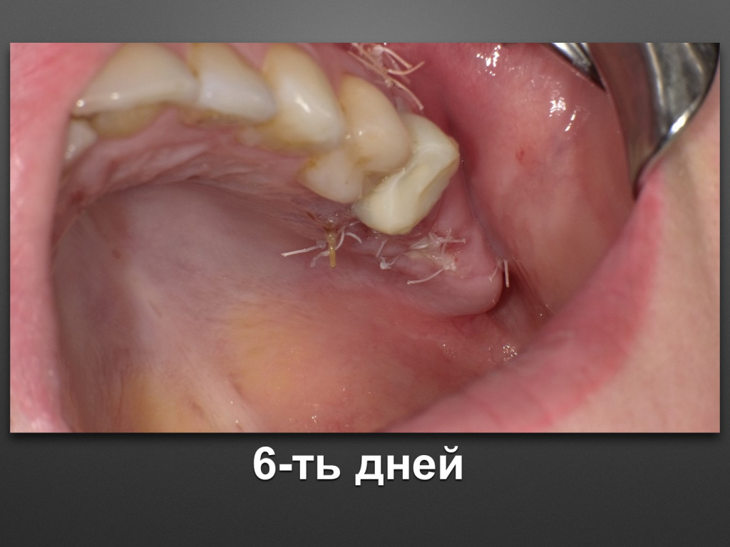Биоимплант ГАП. Имплантация в дистальном отделе