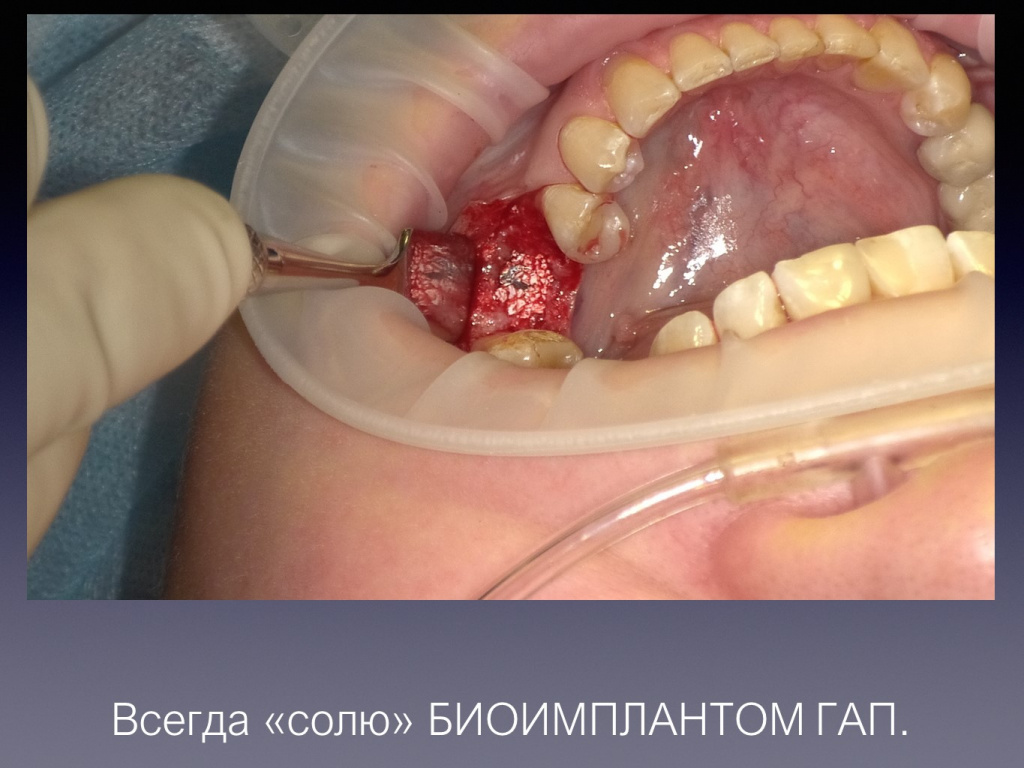 Постановка имплантата после презервации