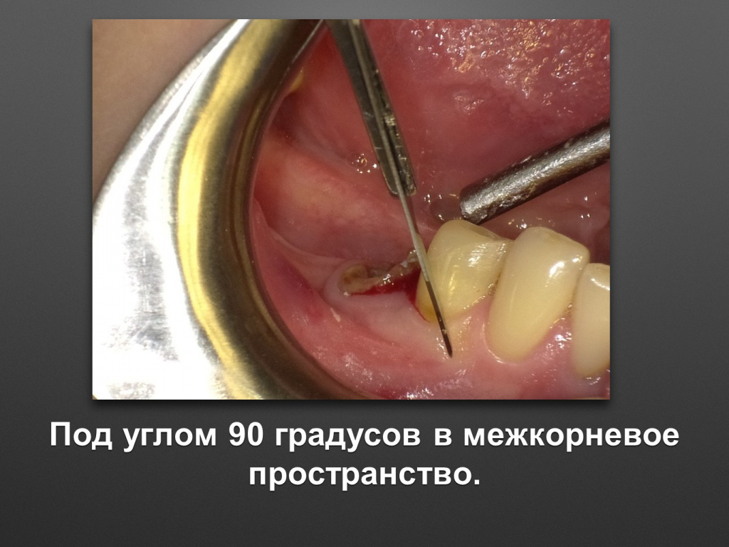 Горизонтальное увеличение альвеолярного отростка