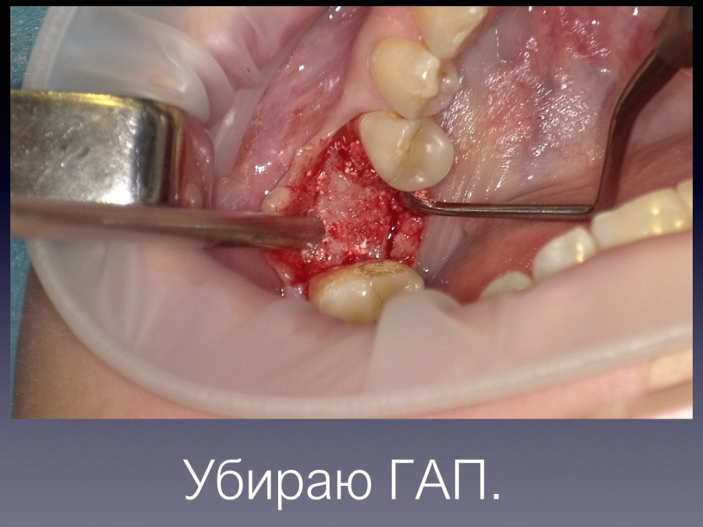 Постановка имплантата после презервации