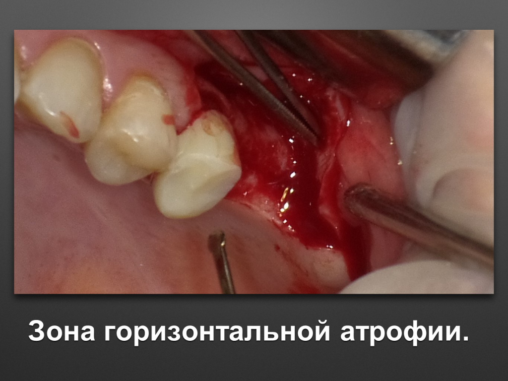 Биоимплант ГАП. Имплантация в дистальном отделе