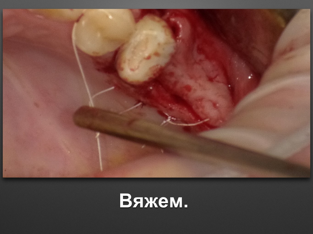 Биоимплант ГАП. Имплантация в дистальном отделе