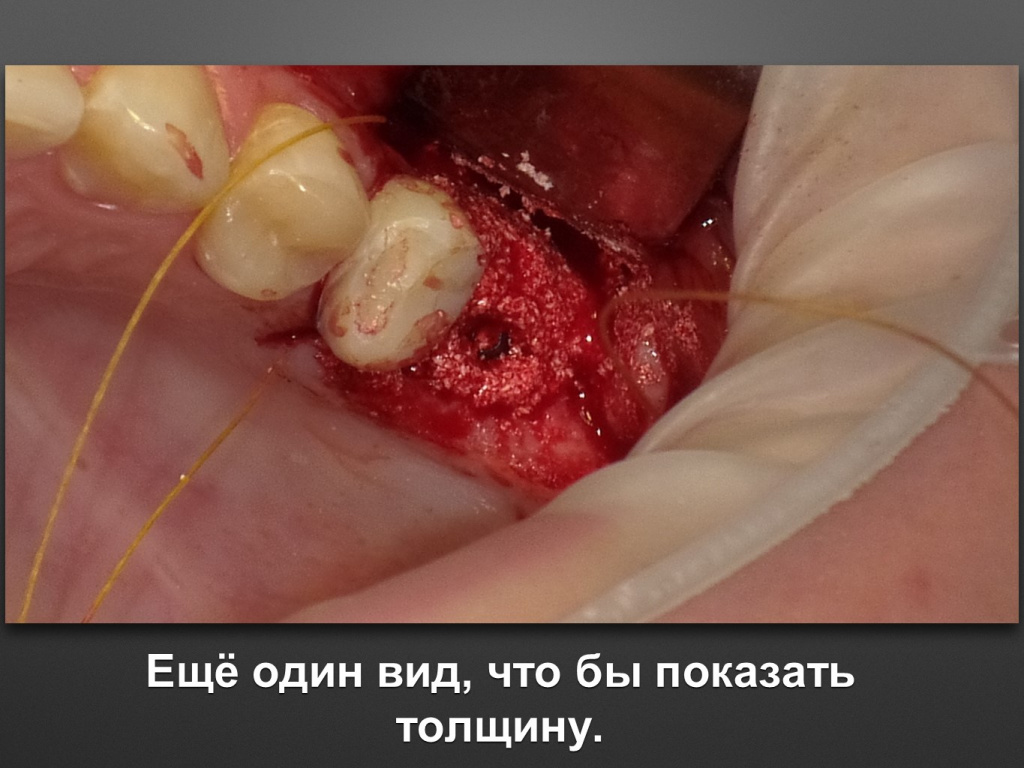 Биоимплант ГАП. Имплантация в дистальном отделе