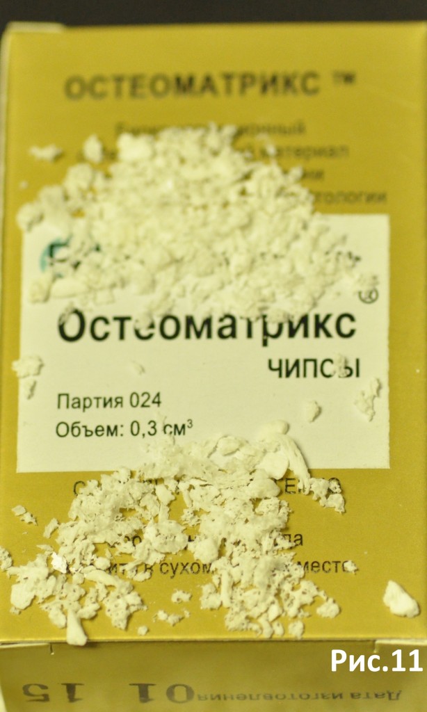 расщепление альвеолярного отростка