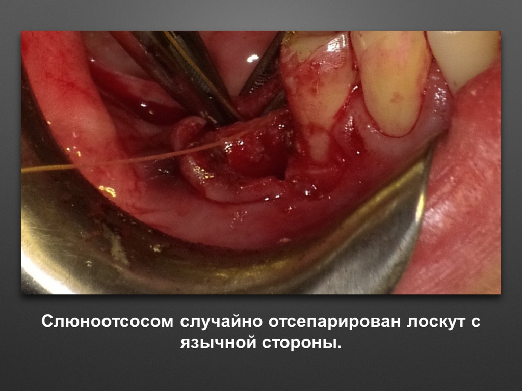 Горизонтальное увеличение альвеолярного отростка