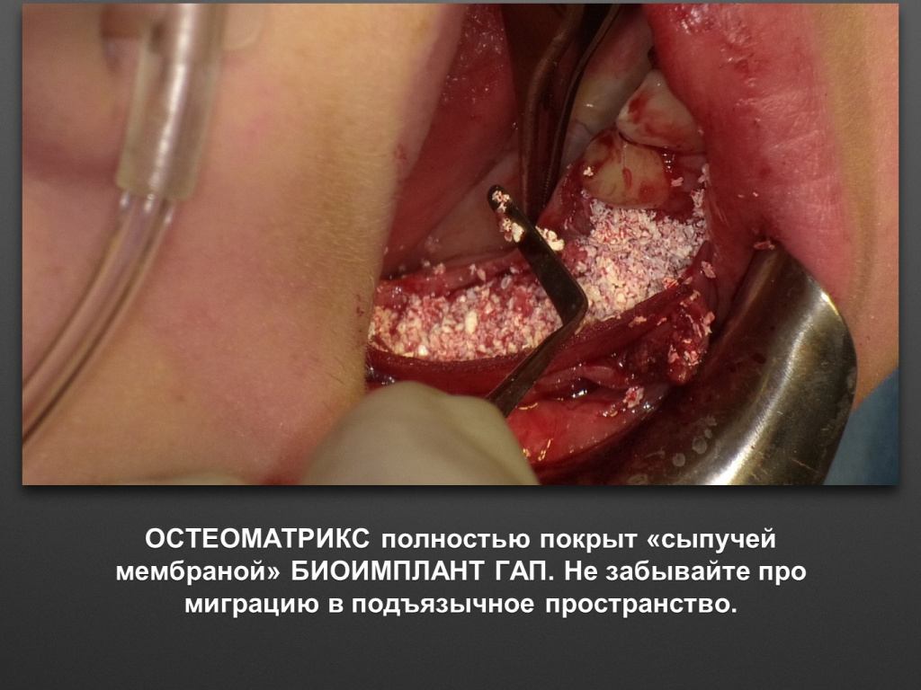 Горизонтальное увеличение альвеолярного отростка