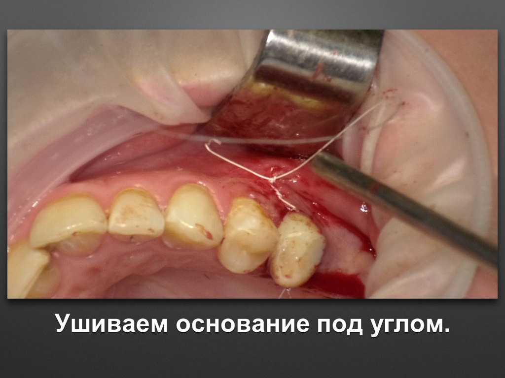 Биоимплант ГАП. Имплантация в дистальном отделе