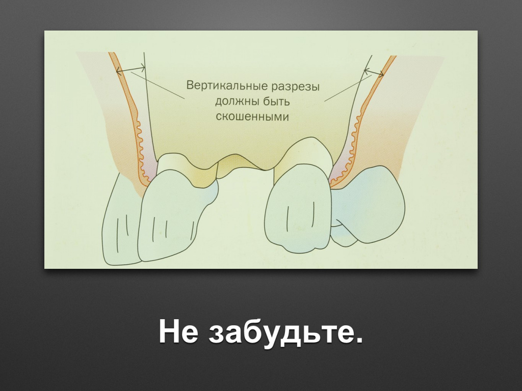 Биоимплант ГАП. Имплантация в дистальном отделе