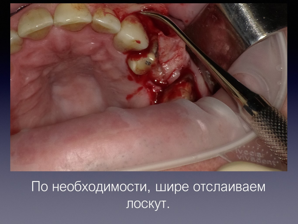 Постановка импланта