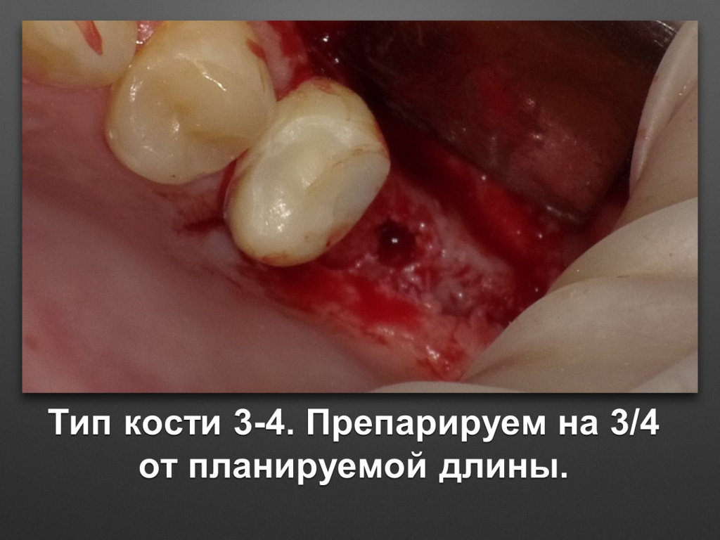 Биоимплант ГАП. Имплантация в дистальном отделе