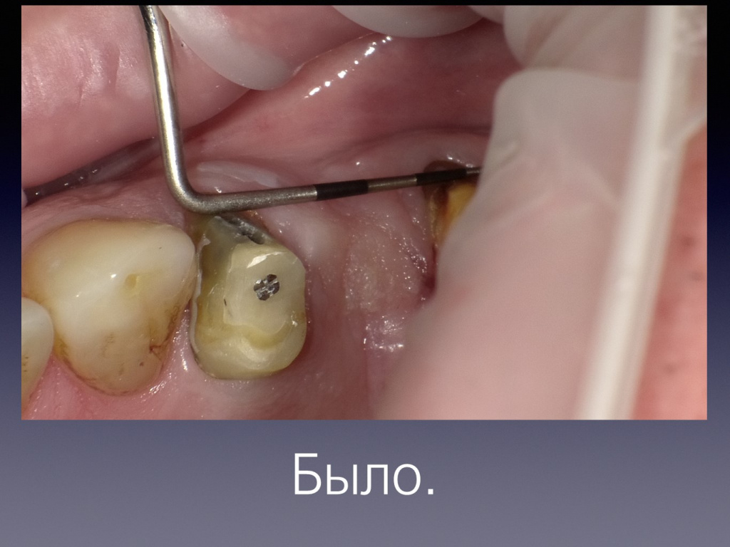 Постановка импланта