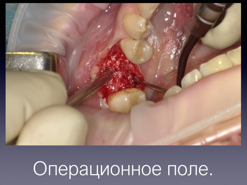 Постановка имплантата после презервации