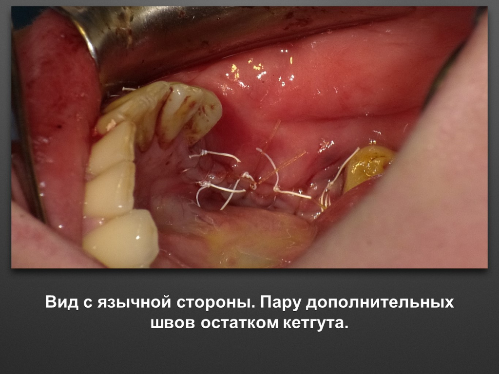 Горизонтальное увеличение альвеолярного отростка