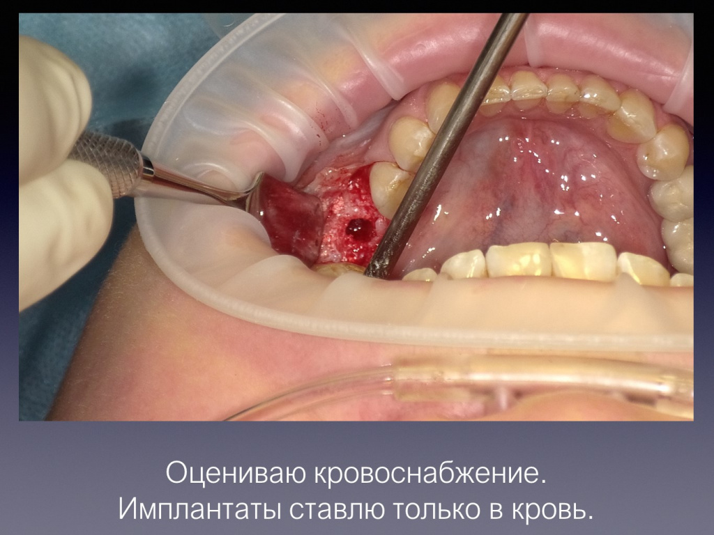Постановка имплантата после презервации