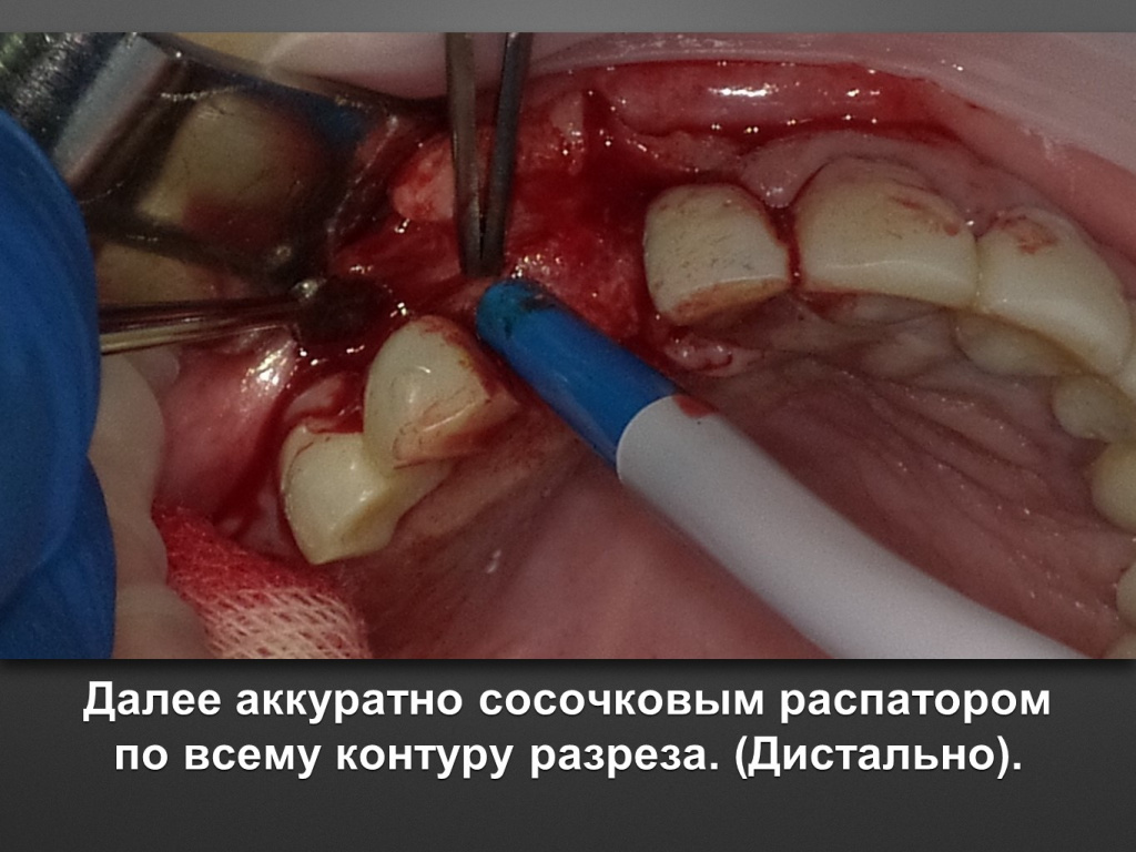 БАЛДЕЙ НОГА