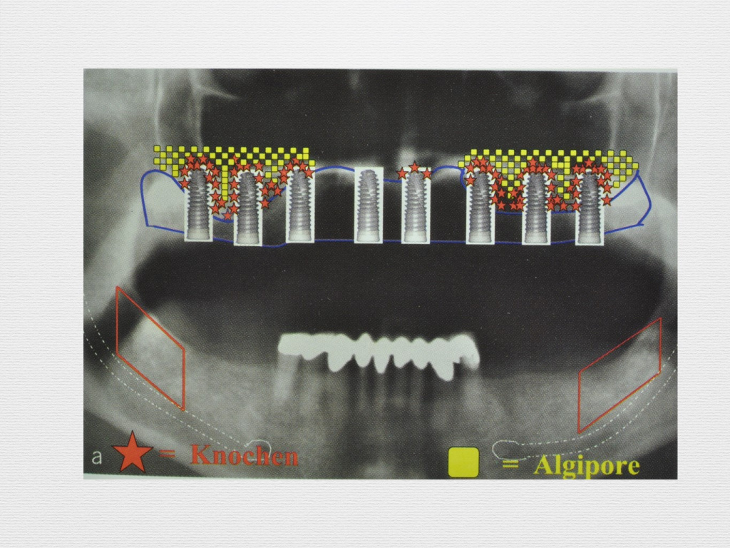 Принцип направленной костной регенерации