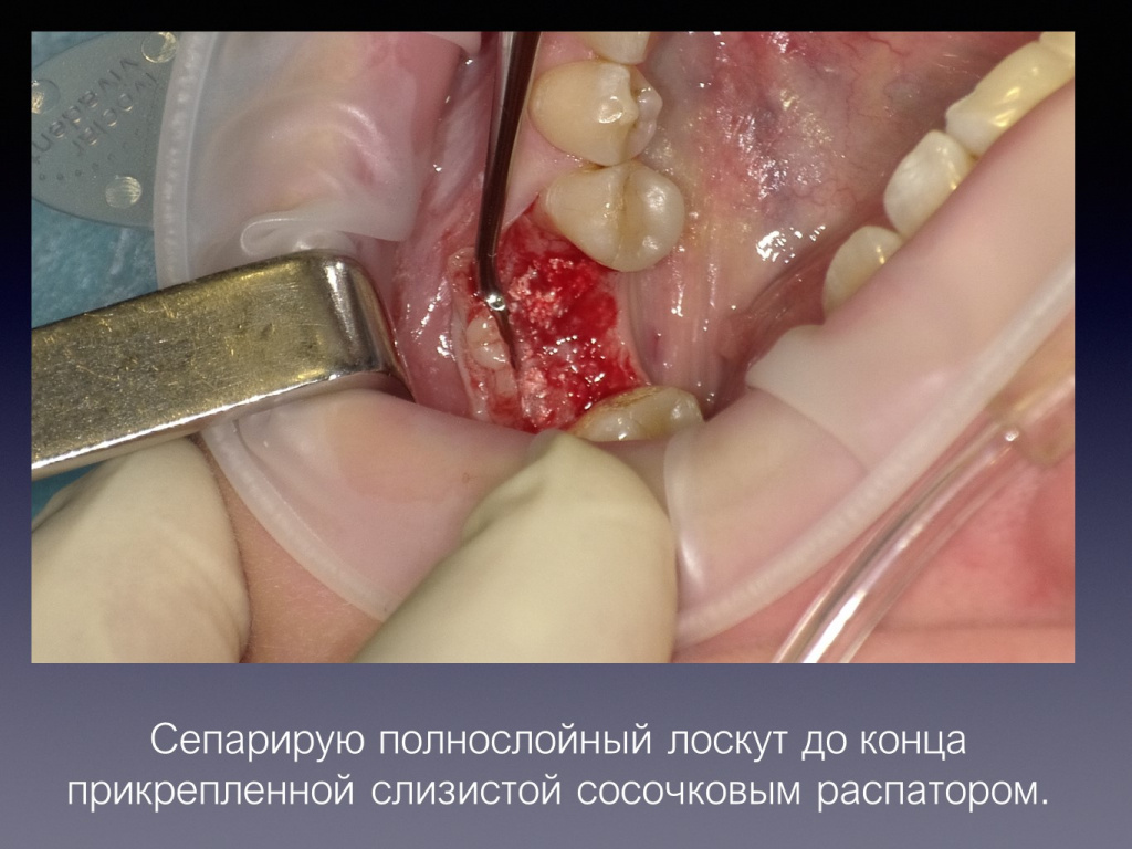Постановка имплантата после презервации