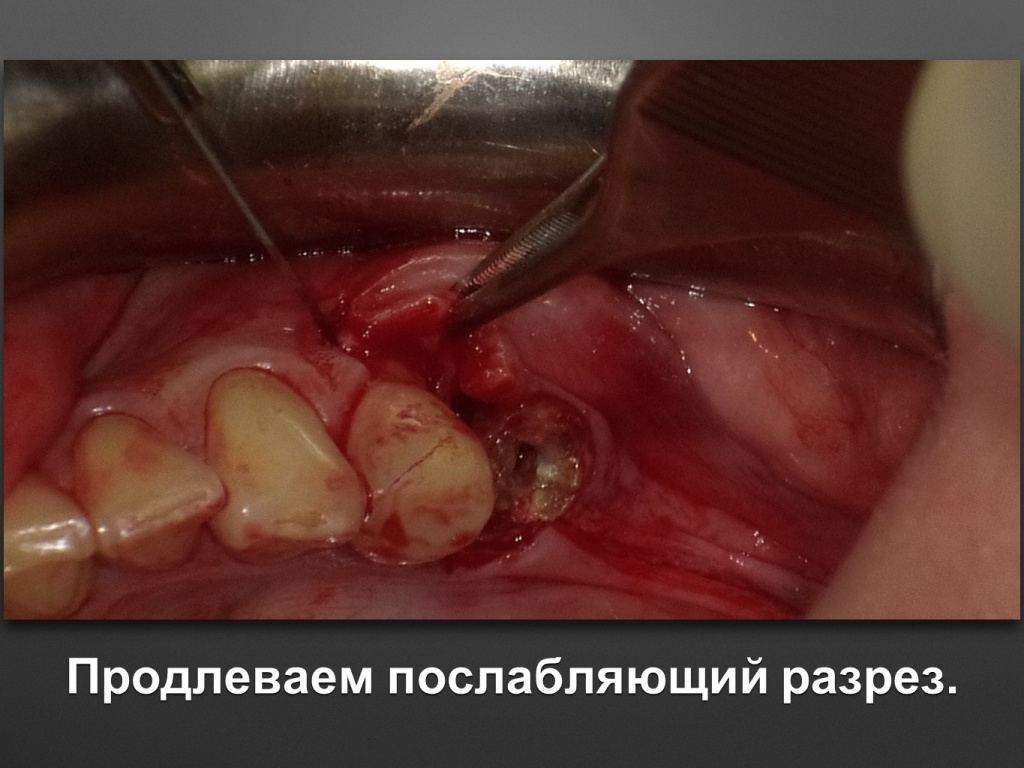Горизонтальное увеличение альвеолярного отростка