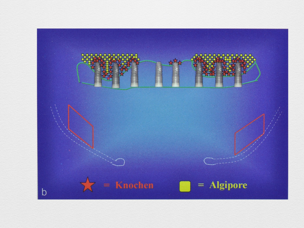 Принцип направленной костной регенерации