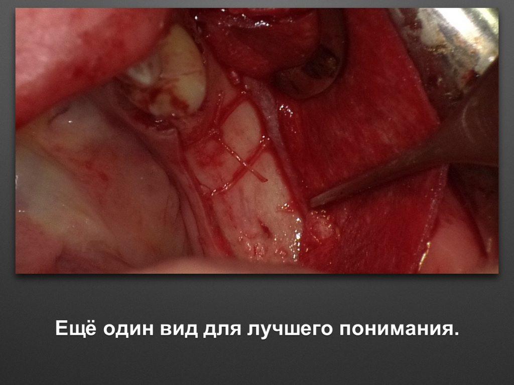 Горизонтальное увеличение альвеолярного отростка