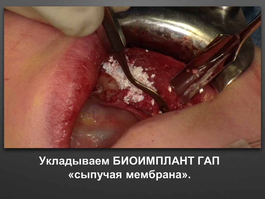 Горизонтальное увеличение альвеолярного отростка
