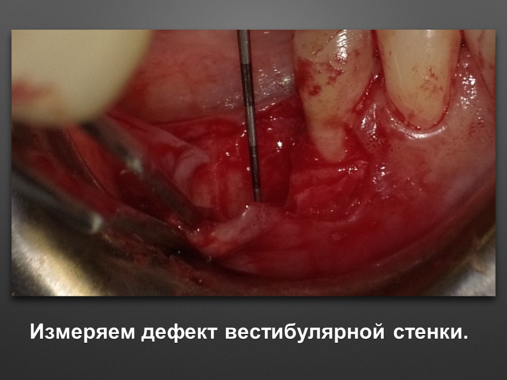 Горизонтальное увеличение альвеолярного отростка