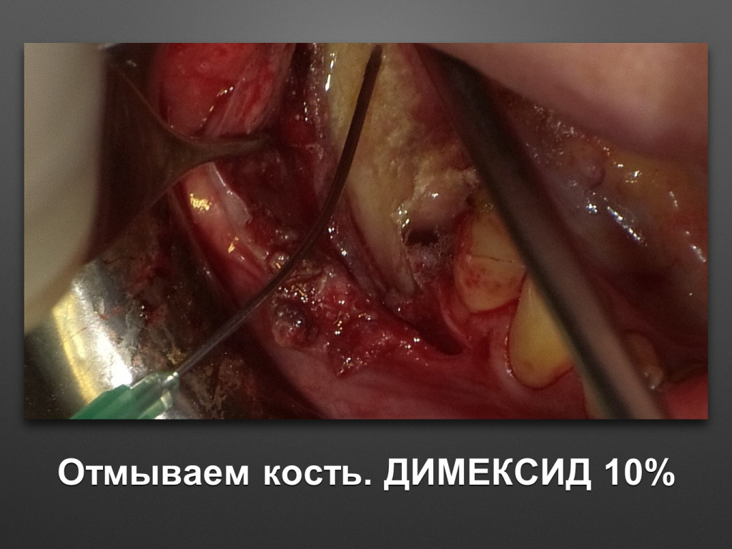 Горизонтальное увеличение альвеолярного отростка