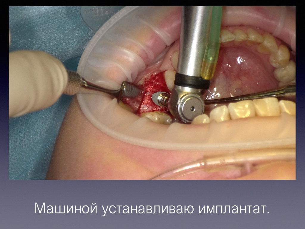 Постановка имплантата после презервации