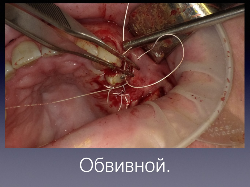 Постановка импланта
