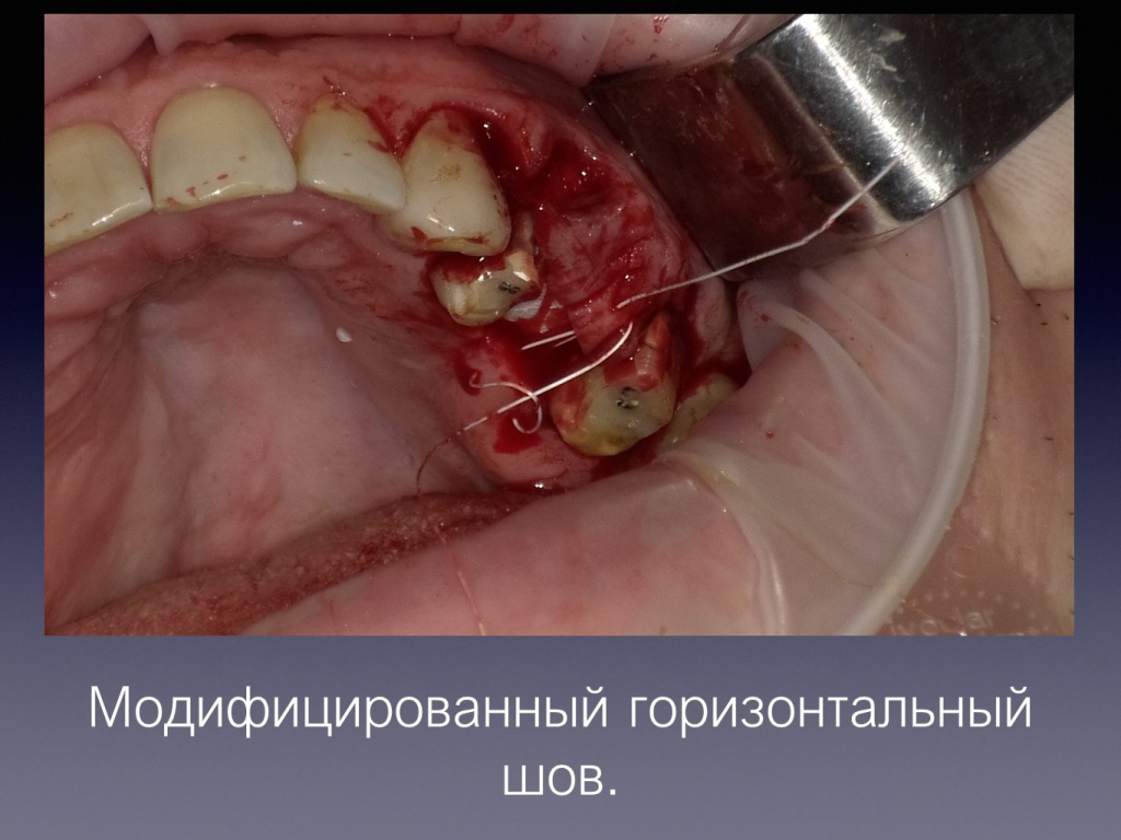 Постановка импланта