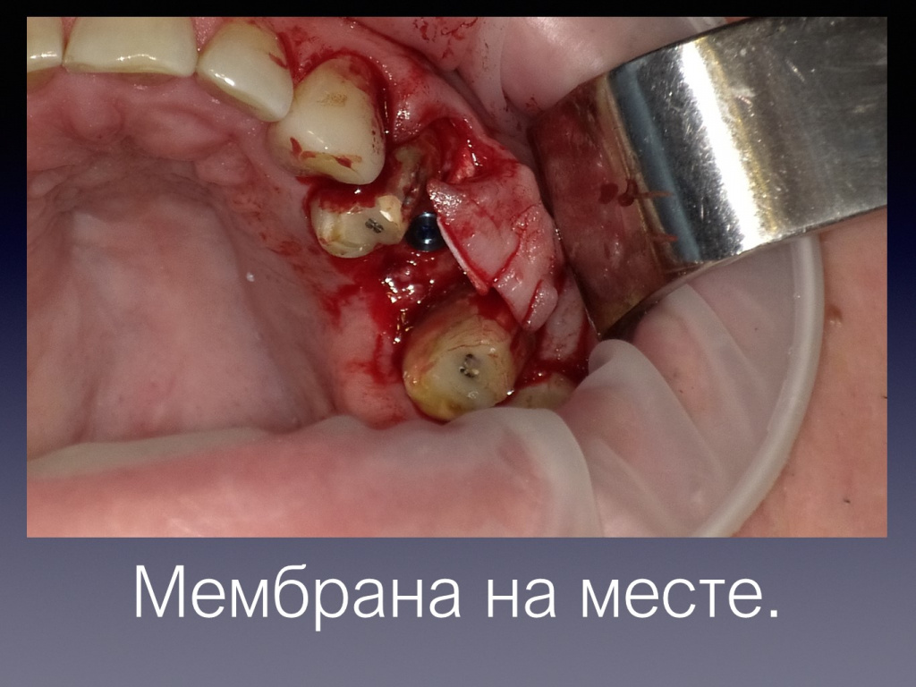 Постановка импланта