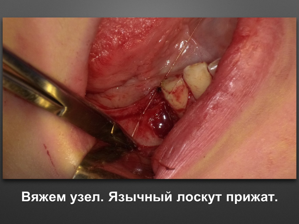 Горизонтальное увеличение альвеолярного отростка