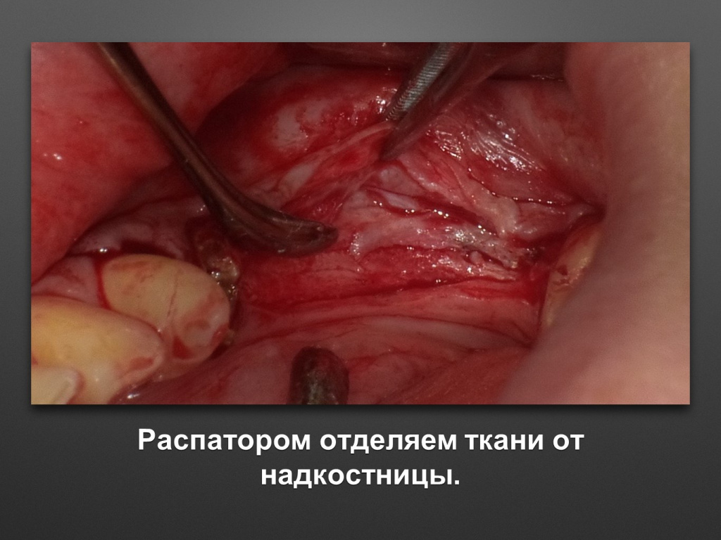 Горизонтальное увеличение альвеолярного отростка