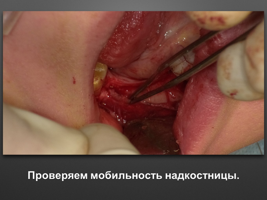 Горизонтальное увеличение альвеолярного отростка