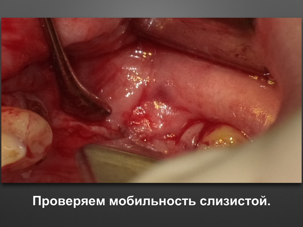 Горизонтальное увеличение альвеолярного отростка