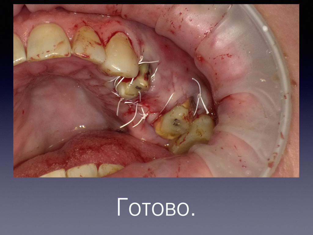 Постановка импланта