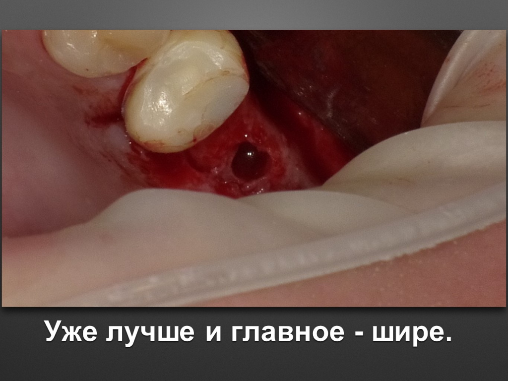 Биоимплант ГАП. Имплантация в дистальном отделе