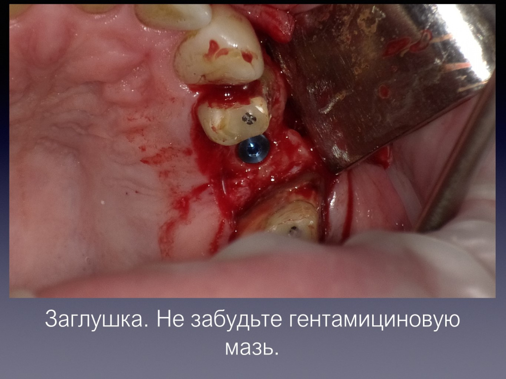 Постановка импланта